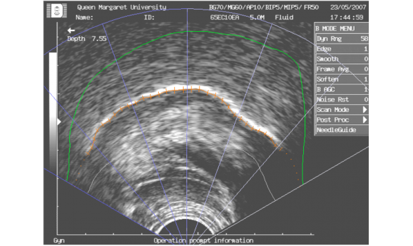 Probe Skewing Effects & Kinect Head-tracking in Tongue Contour Imaging