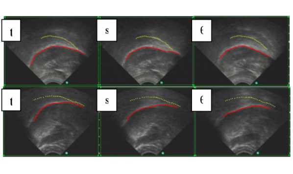 Segment Constants and Speaker Constants in English Coronal Obstruents