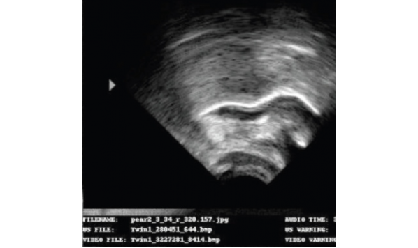 An Ultrasound Study of the Acquisition of North American English /ɹ/