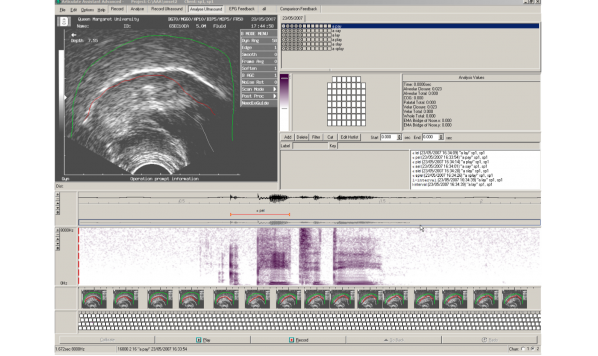 Retroflex versus bunched /r/ in ultrasound intervention: One shape does not fit all?