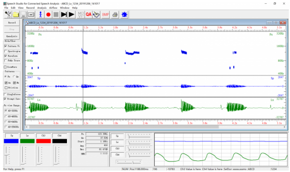 A Longitudinal Study Investigating Synchronization in a Singing Quintet