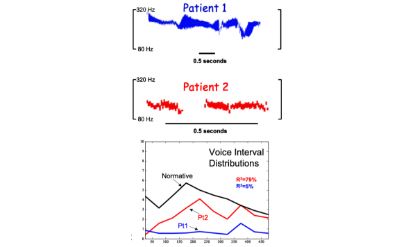 Voice Timing in Two Parkinson’s Disease (PD) Patients following Subthalamic Nucleus Deep Brain Stimulation