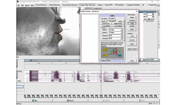 Image analysis tutorial 6 How to measure lip distance