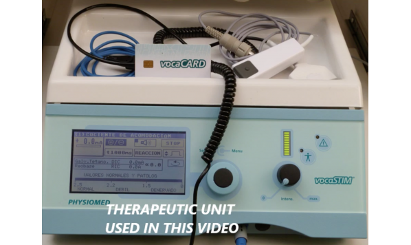 Treatment of Layrenx Pareses with vocaSTIM